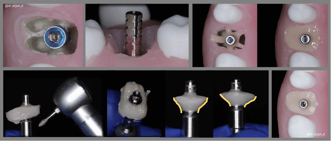 Blog image using a customised healing abutment for immediate implant by dr arjun krishnakumar