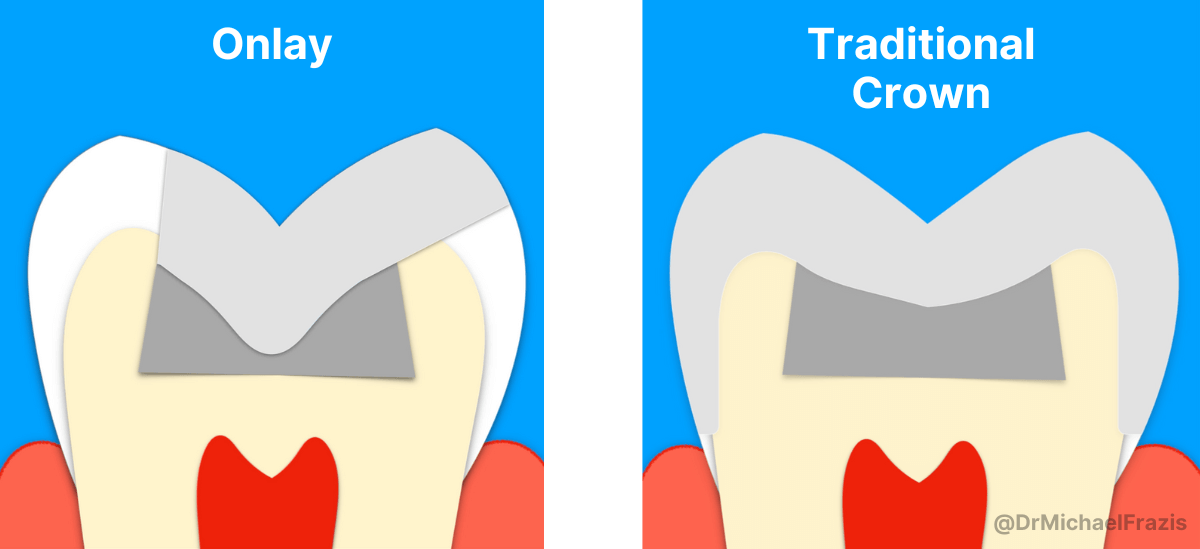 Onlay vs Traditional Crown Illustration by Dr Michael Frazis