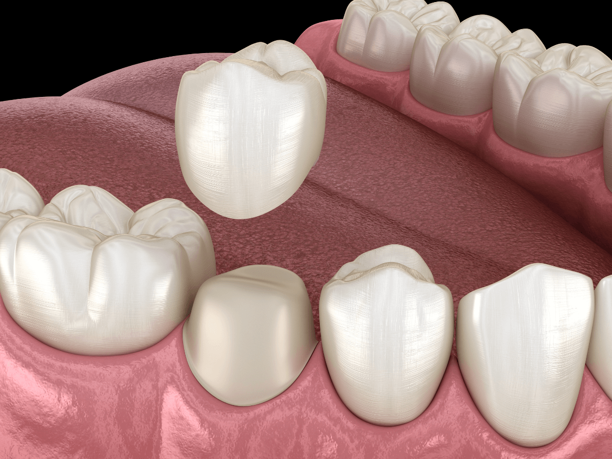 Crowns - Building A Career in Restorative Dentistry