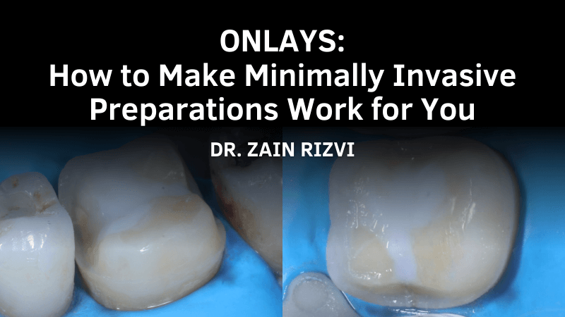 MKT-240812-Zain Thumbnail Onlays how to make minimally invasive preparations work for you