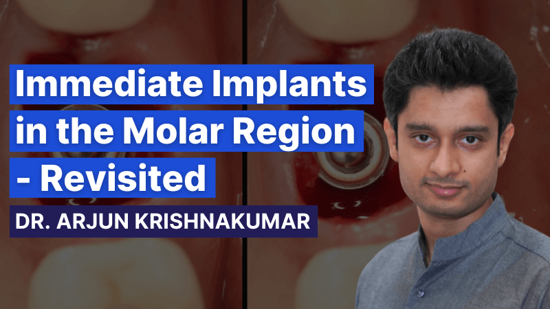 MKT-240908-Arjun Website Thumbnail immediate implants in the molar region revisited