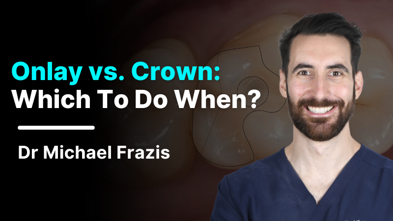 MKT-240920-Frazis Website Thumbnail onlay vs crown 800