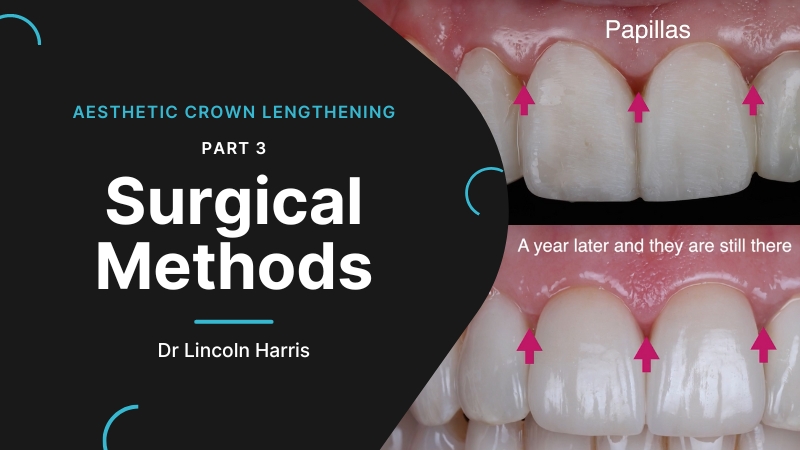 Video-Thumbnail-Harris-aesthetic-crown-lengthening-part-3-800