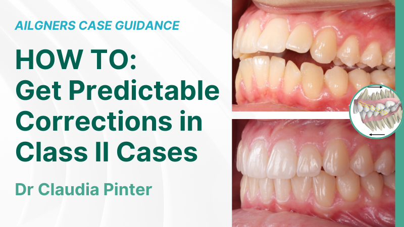 -Claudia-Case-Guidance Thumbnail HOW TO Get Predictable Corrections in Class II Cases 